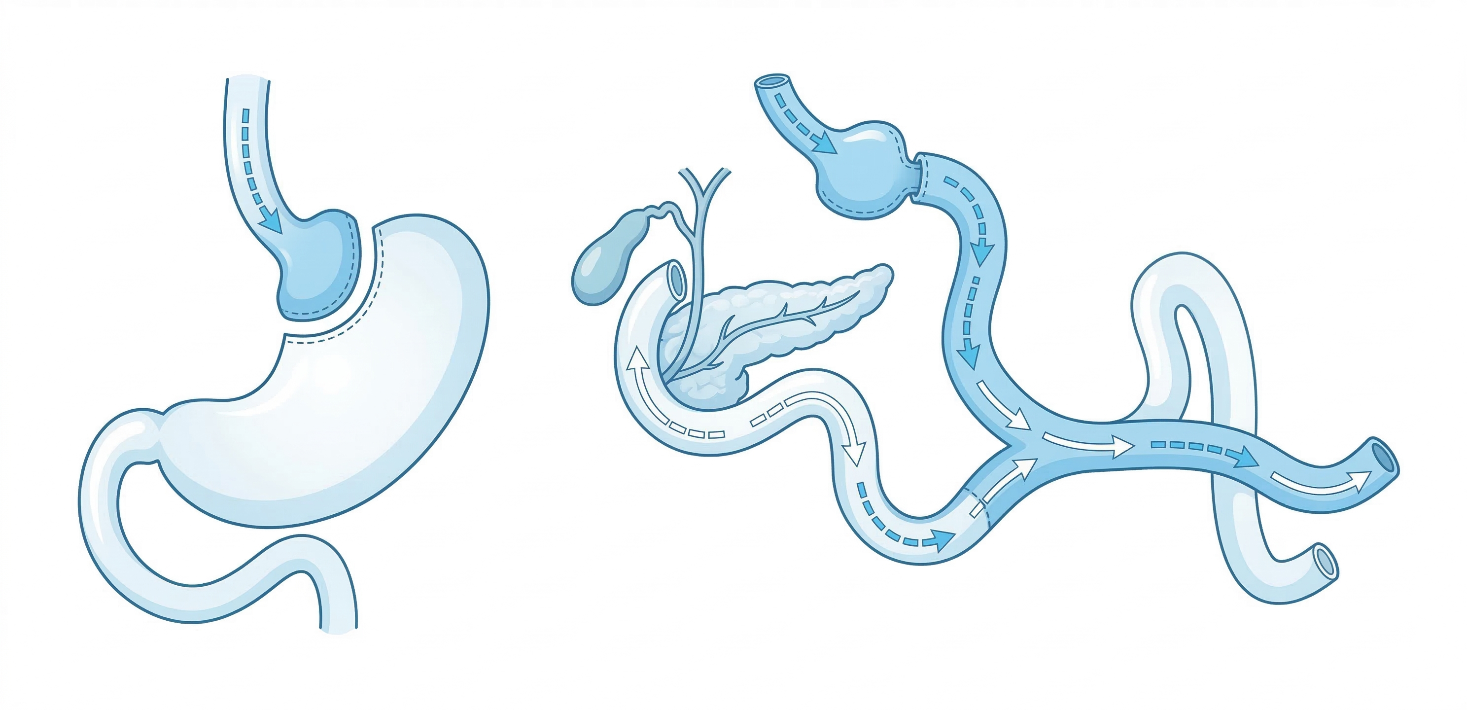 위우회술 경로 및 흡수 제한 원리 일러스트