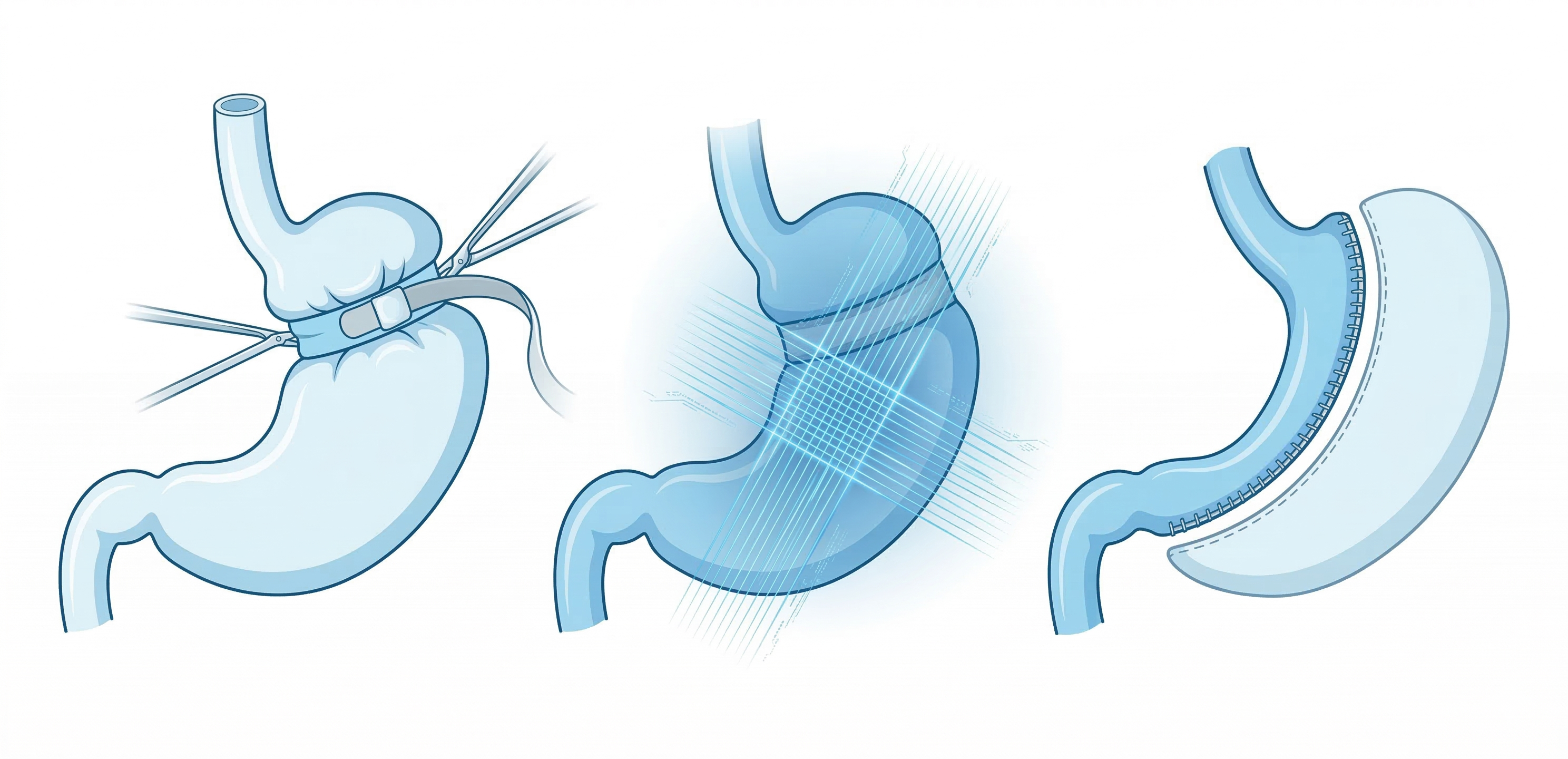 밴드 제거 및 새로운 수술법 전환 경로 일러스트