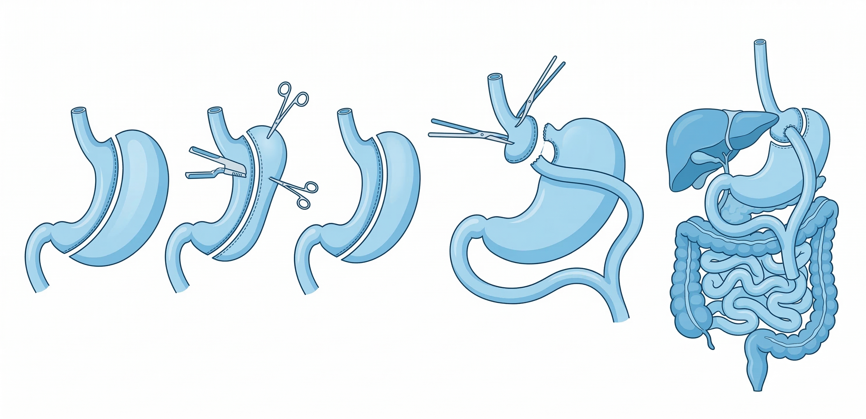확장된 위의 재절제 및 십이지장 우회술 전환 과정을 보여주는 정밀 일러스트