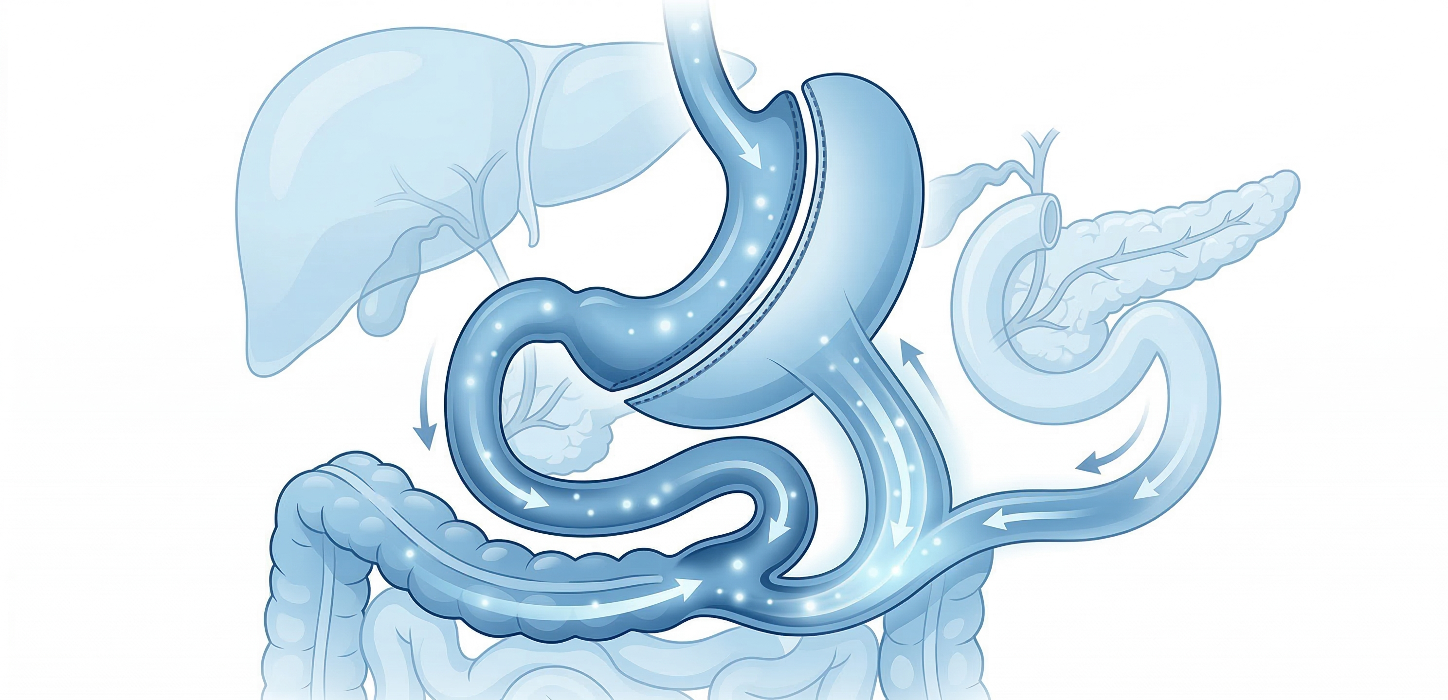 소매절제와 십이지장 우회 경로가 결합된 일러스트 영역