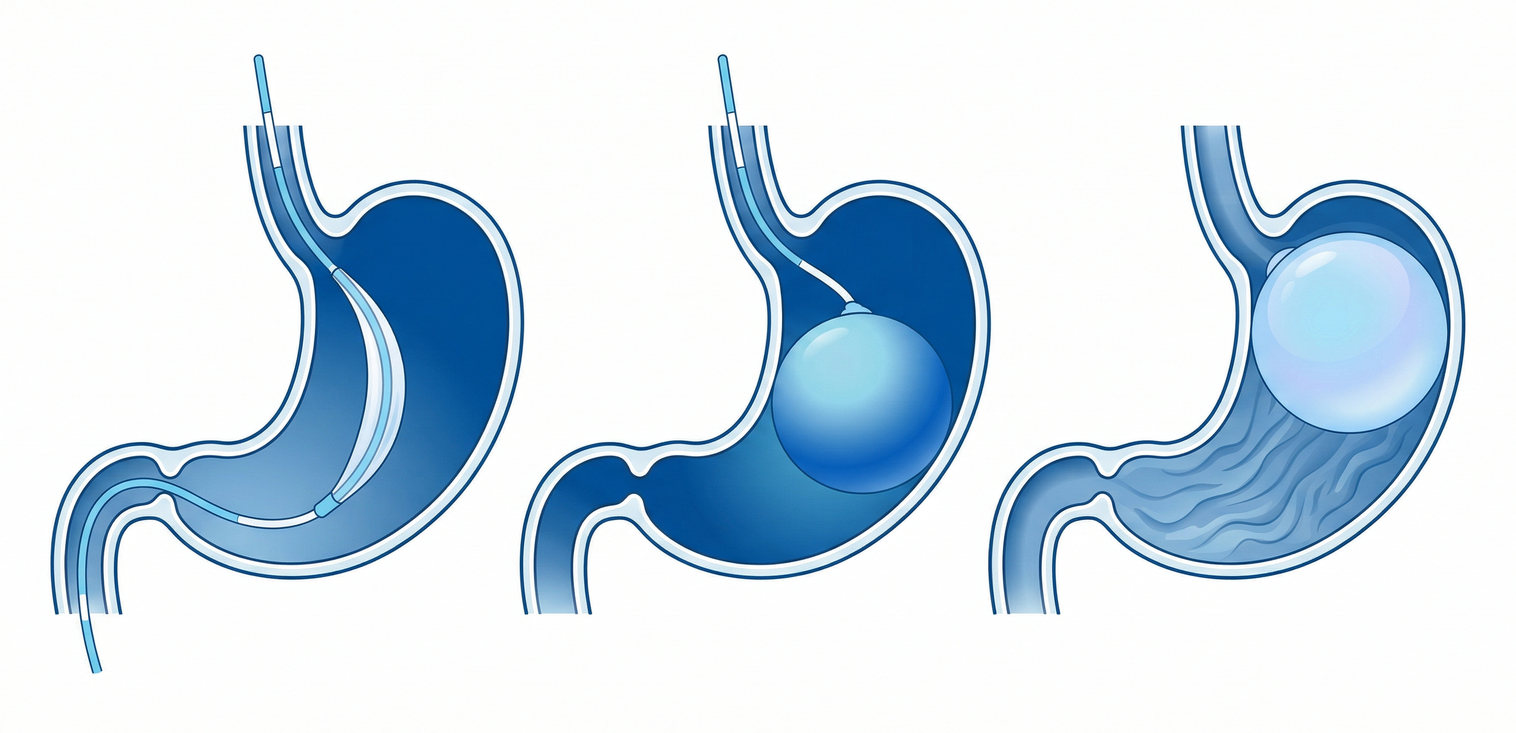 위 내부에 거치된 위풍선과 포만감 전달 경로 일러스트