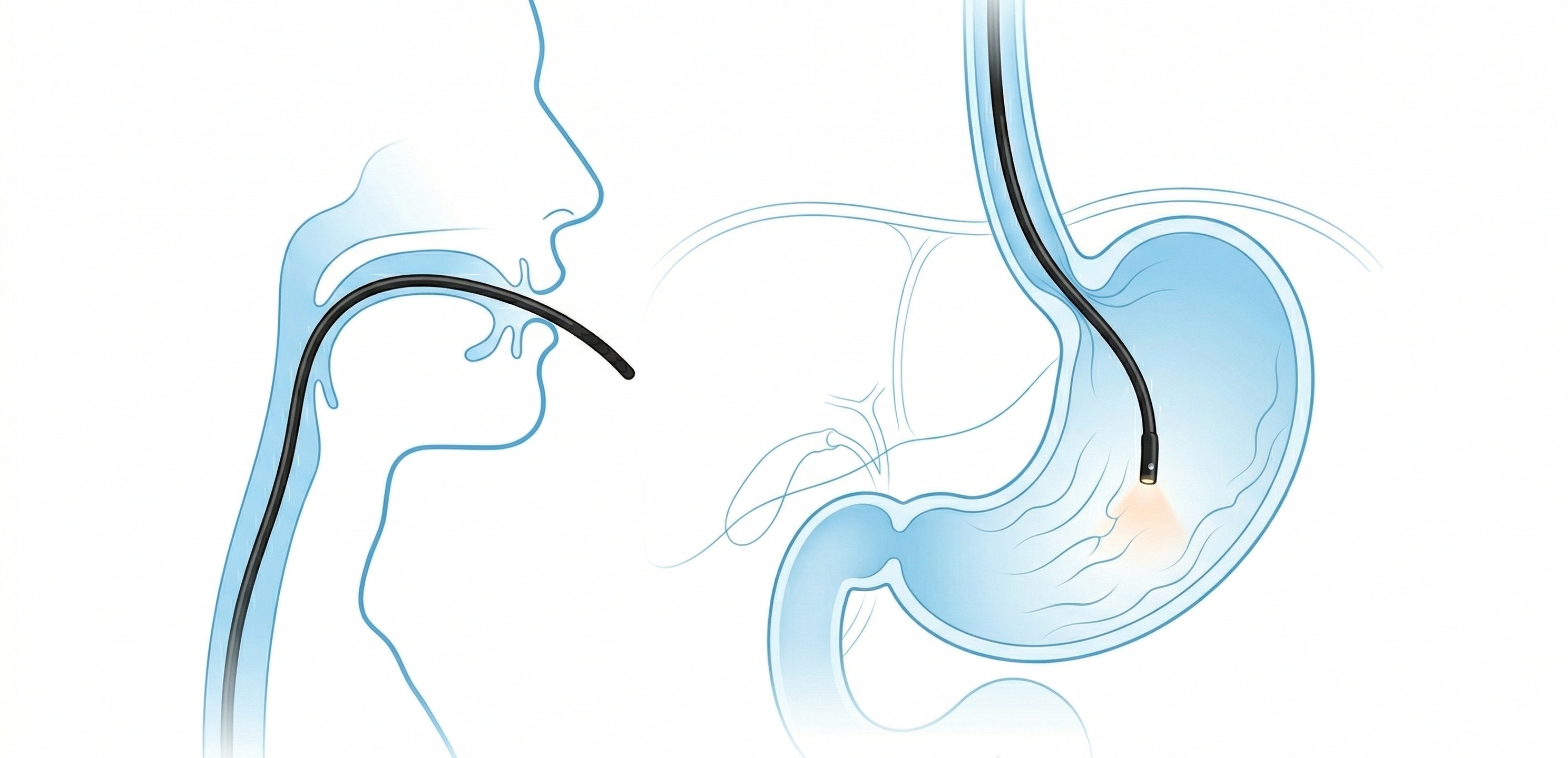 입을 통해 삽입된 내시경을 이용한 위 용적 축소 과정 일러스트