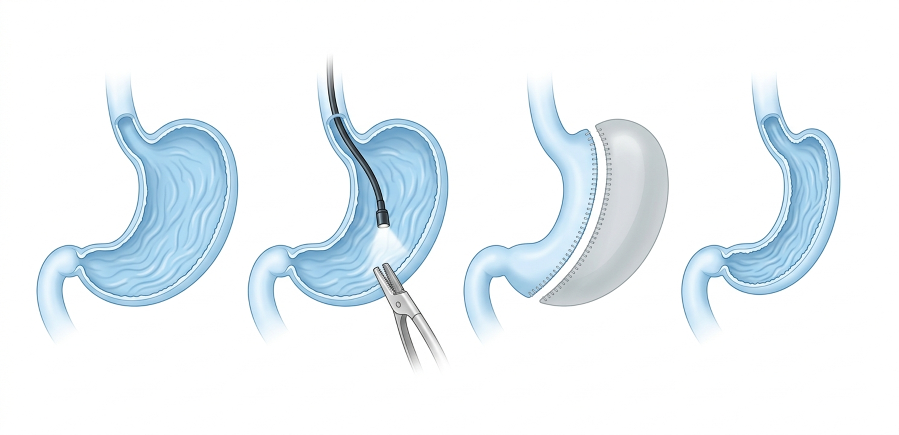 내시경 봉합 기구를 이용한 위벽 폴딩 및 축소 과정 일러스트