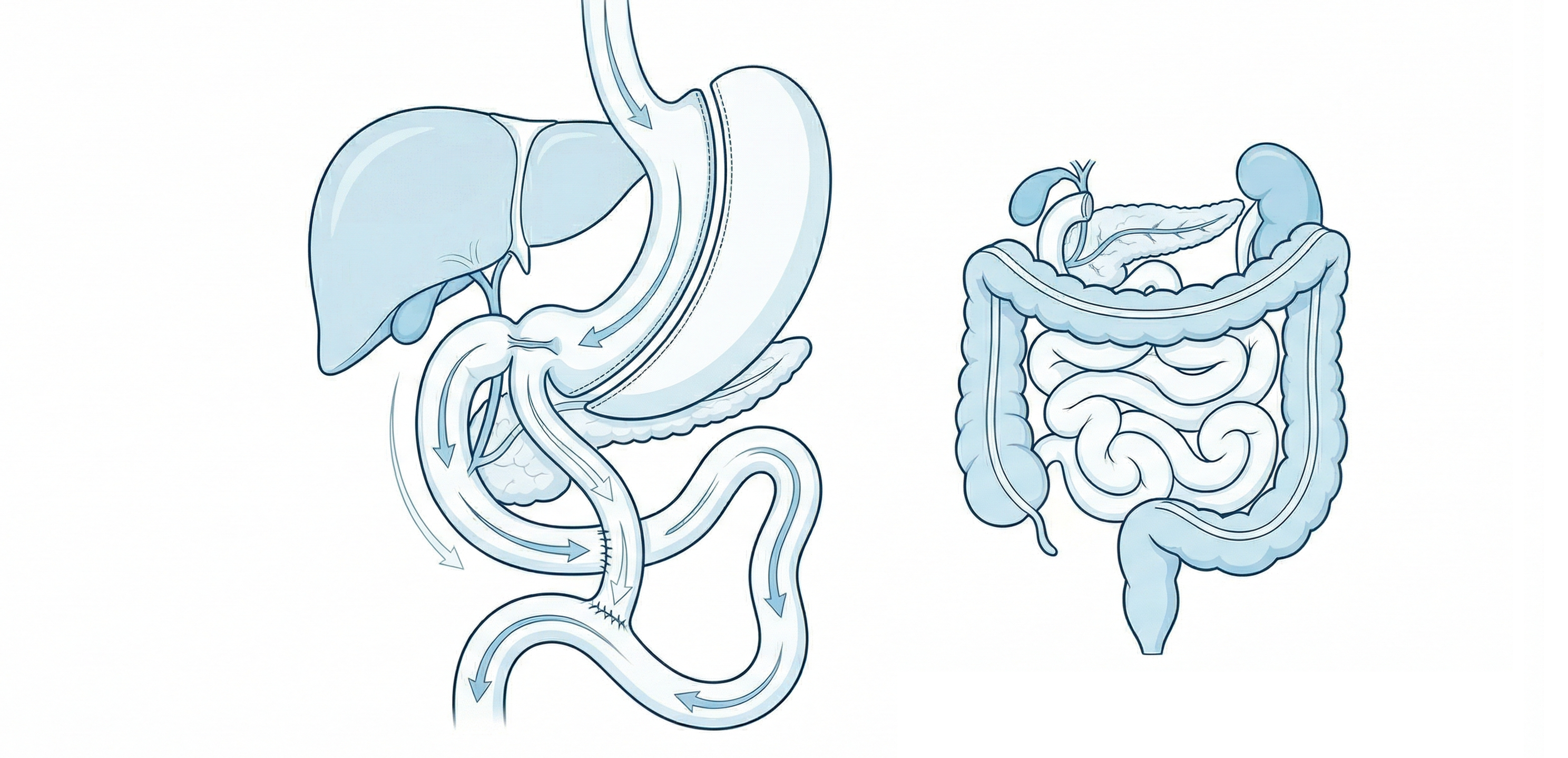 십이지장 우회 경로 재설정 및 소장 길이 조절 일러스트