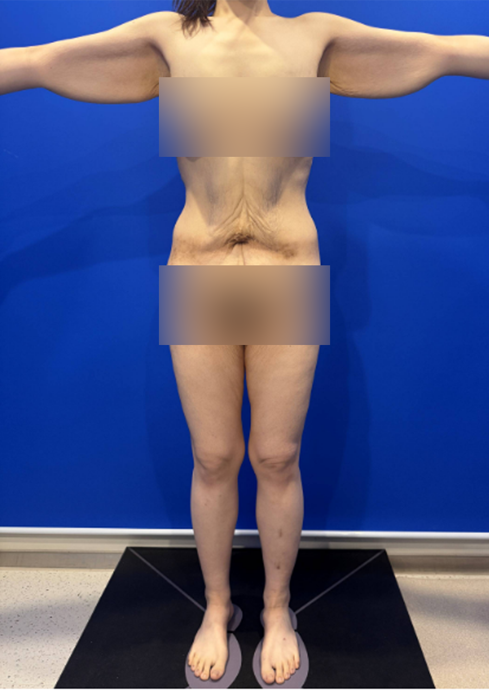 팔뚝·복부 처짐 개선 전 이미지